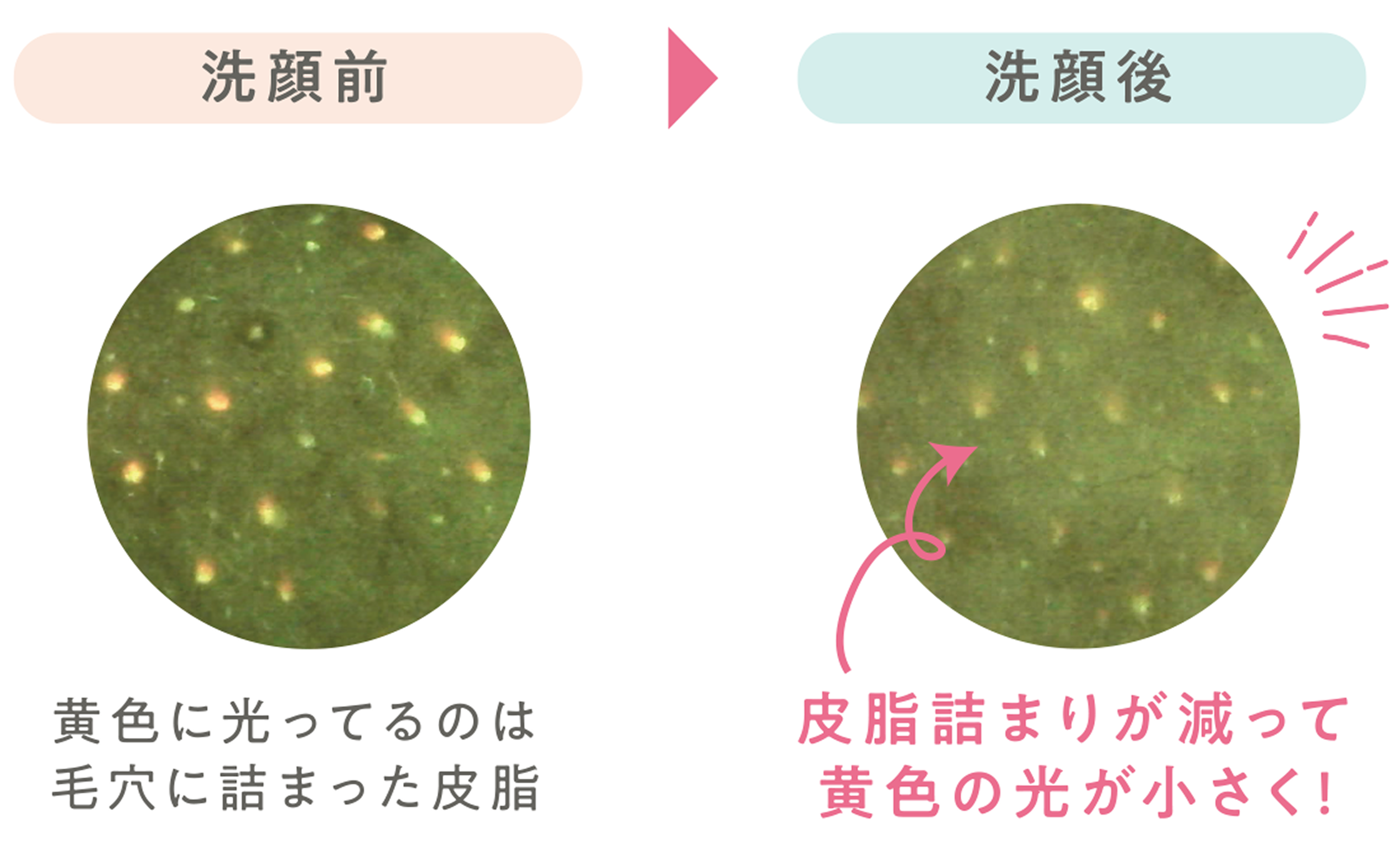 特殊カメラ撮影：洗顔前後の毛穴汚れ比較。皮脂詰まりが減少